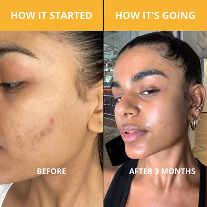 Peel Shot Spray – Instant Skin Brightening & Dark Spot Remover (Kojic Acid + Turmeric)