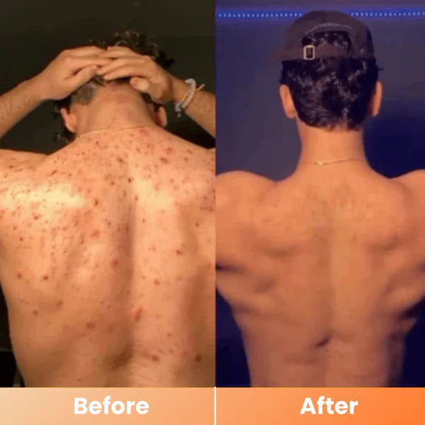 Peel Shot Spray – Instant Skin Brightening & Dark Spot Remover (Kojic Acid + Turmeric)