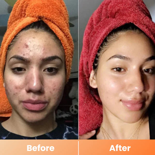 Peel Shot Spray – Instant Skin Brightening & Dark Spot Remover (Kojic Acid + Turmeric)