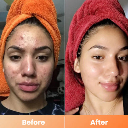 Peel Shot Spray – Instant Skin Brightening & Dark Spot Remover (Kojic Acid + Turmeric)