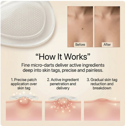 DermaSmooth™ - Tag &amp; Mole Remover Patches ❤️🩹 | Buy 1 Get 1 Free ✨