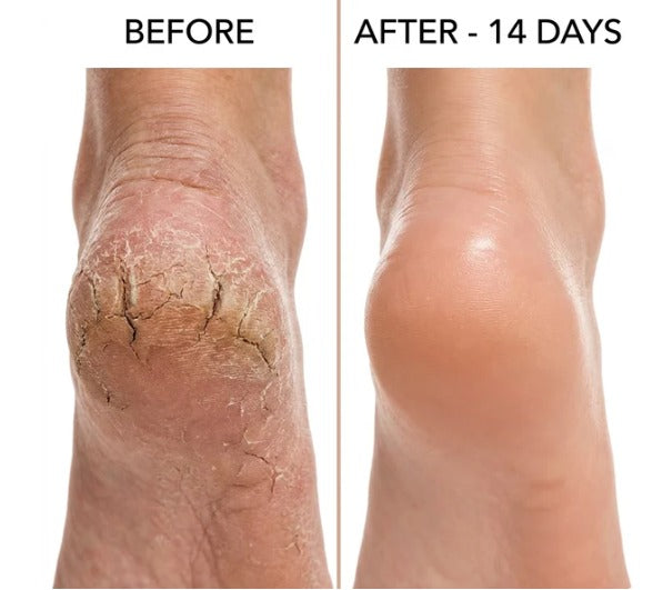 Healing Therapy Gel Socks✨ | Buy One Get One Free 🔥| Adjustable Size